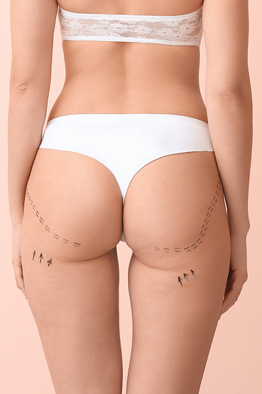 cosmetic surgery butt